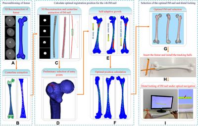 Determination of intramedullary nail based on centerline adaptive registration